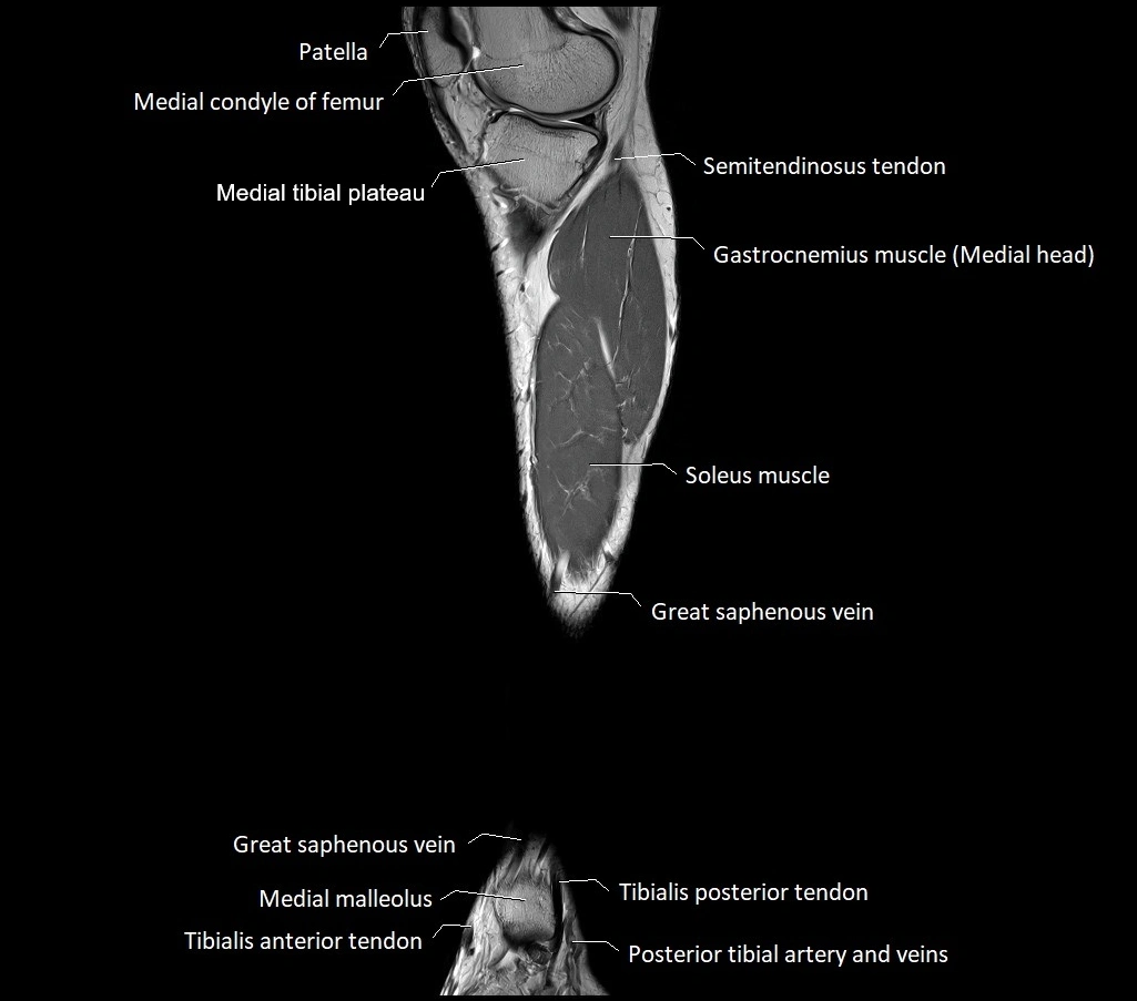 Lower leg sagittal anatomy 3T MRI image 24.webp